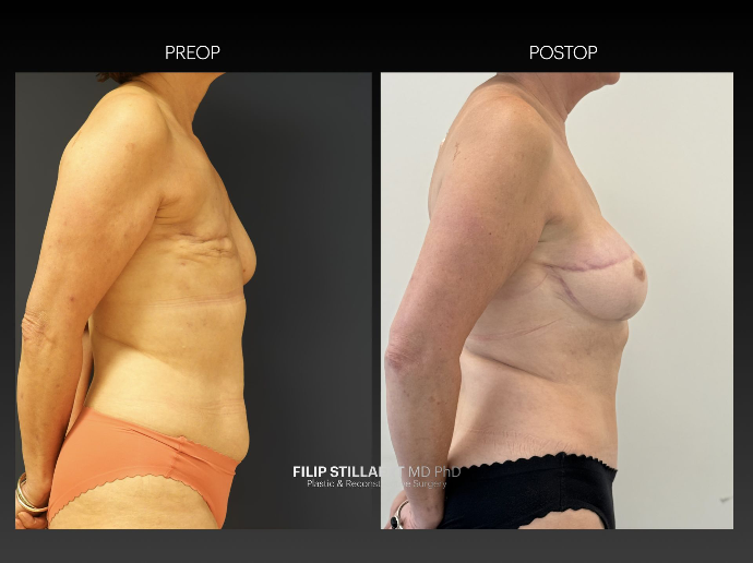 diep flap