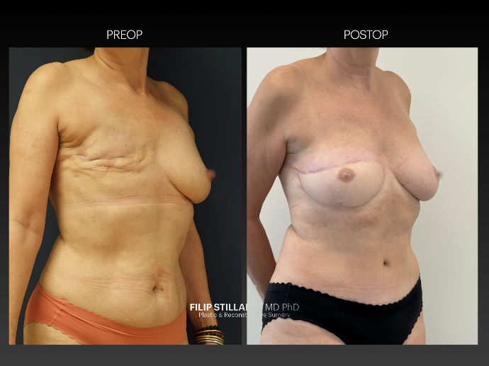 diep flap