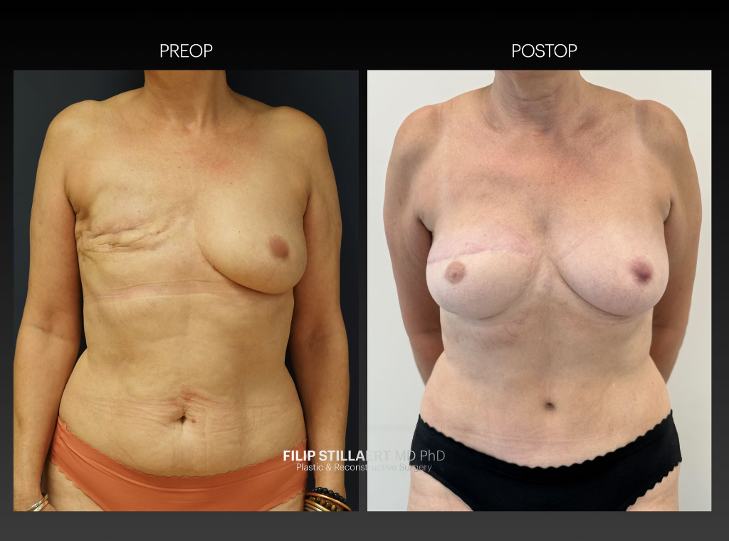 diep flap