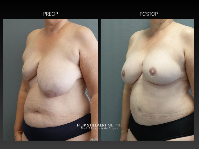 diep flap