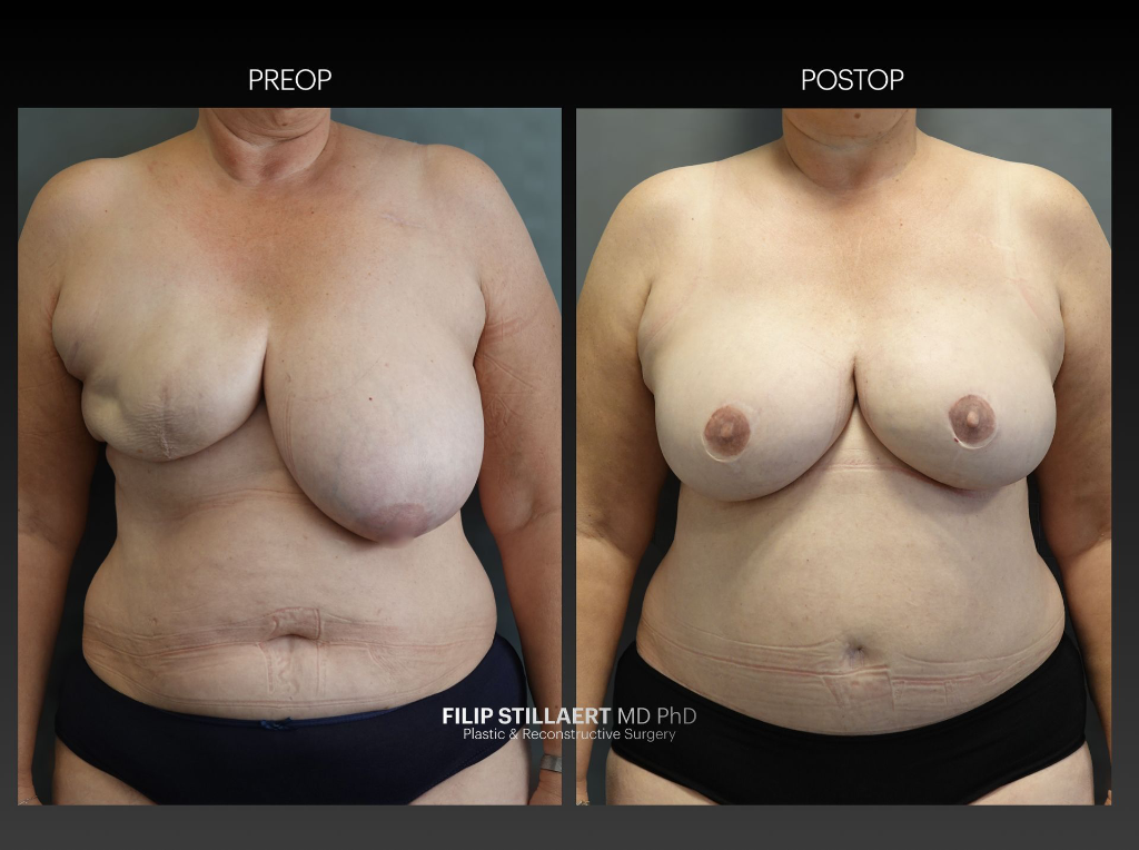 diep flap