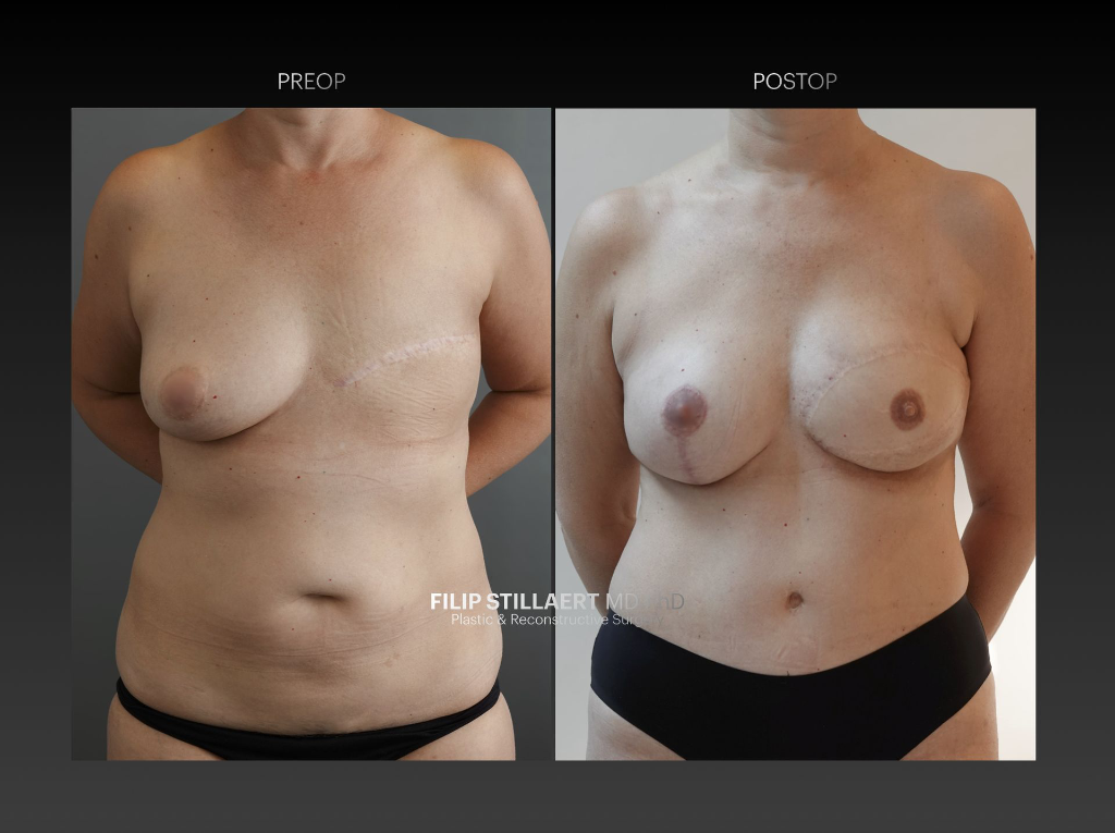DIEP flap