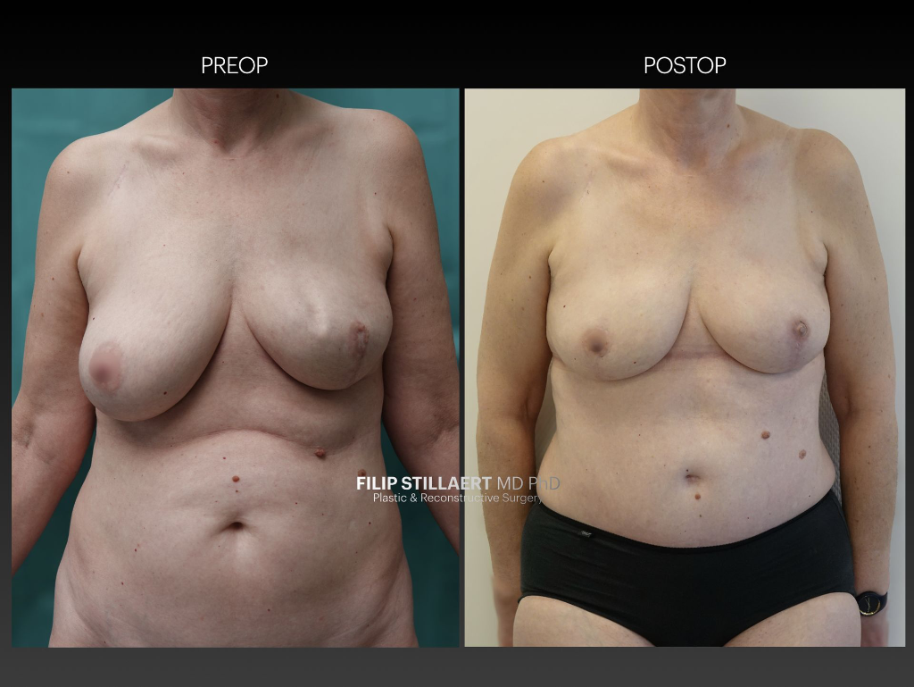 DIEP flap